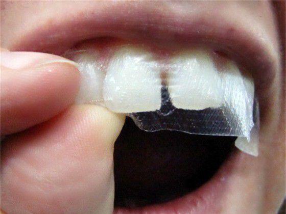 Những mối nguy hiểm từ thuốc tẩy trắng răng tại nhà 