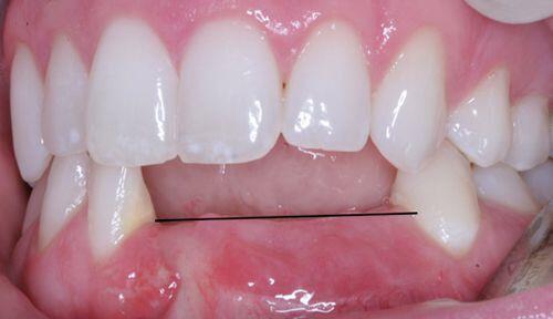 Nguy cơ mất răng từ triệu chứng sưng lợi thông thường