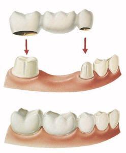 Những phương pháp trồng răng giả hiện nay 1