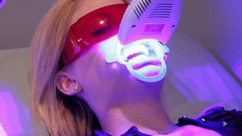 Tẩy trắng răng bằng Laser bao nhiêu tiền?
