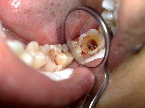 Viêm chóp chân răng là gì ?