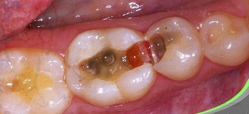 Tổng quát kiến thức về bệnh viêm quanh chóp răng