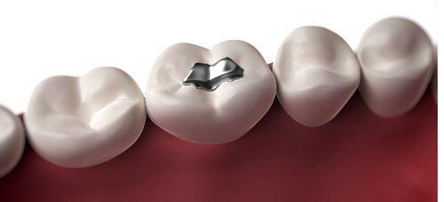 Các loại vật liệu phục vụ phẫu thuật trám răng