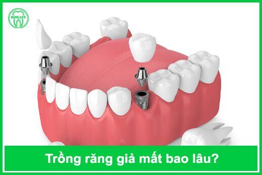 trồng răng giả mất bao lâu