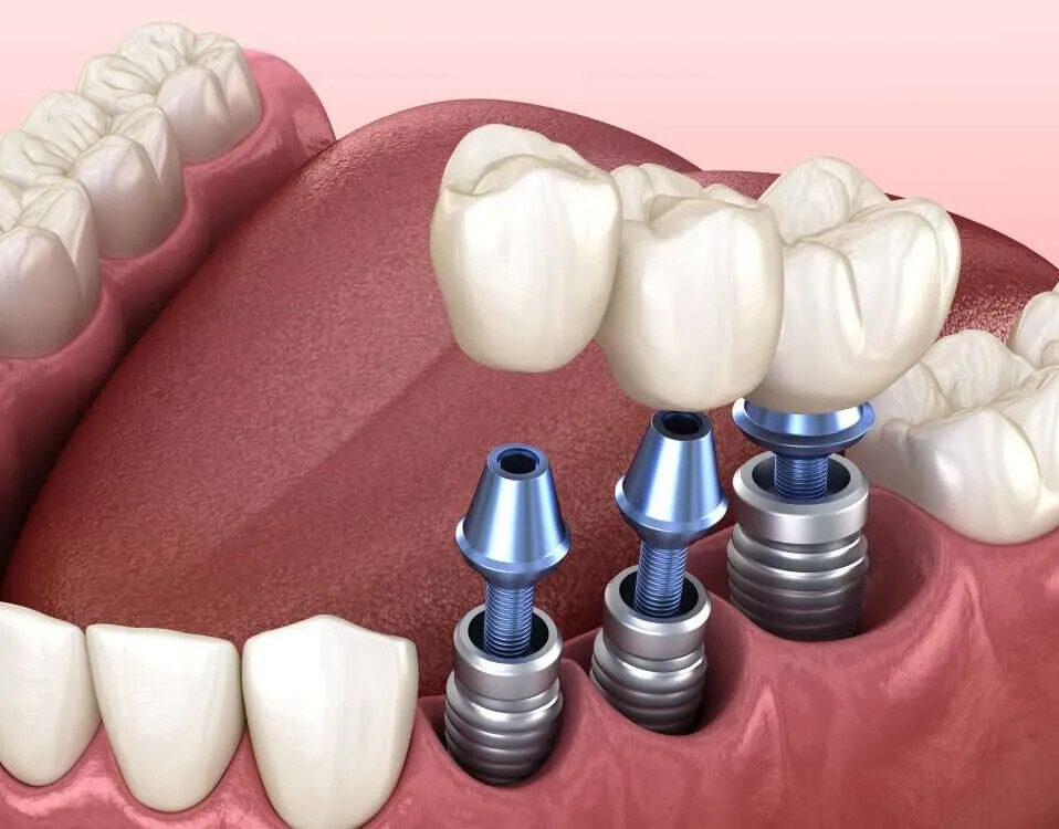 dịch vụ trồng răng implant