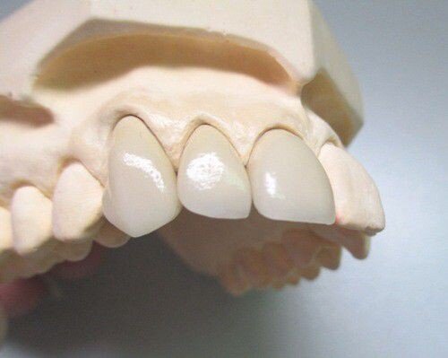 Trồng răng ở đâu tốt và đẹp đảm bảo an toàn