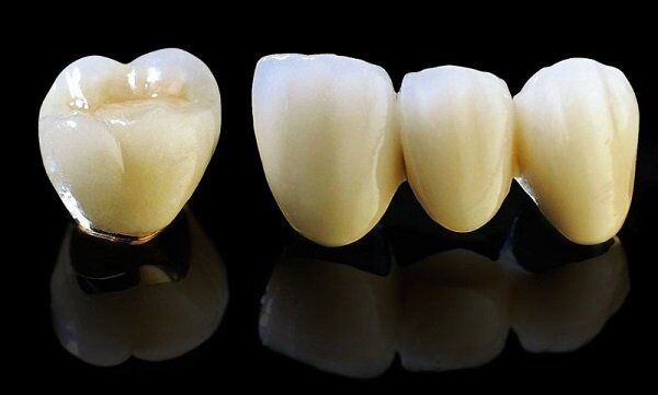 Tuổi thọ của răng sứ Titan bao nhiêu năm là cao nhất?