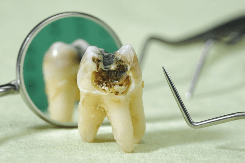 Răng đã nội nha có bền vững