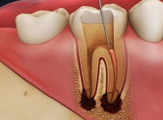 Hiện tượng răng bị chết tủy