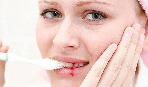 Tuyệt chiêu đơn giản chữa chảy máu chân răng