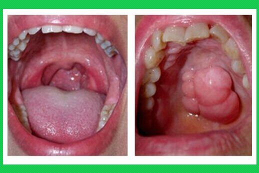 Viêm lợi nguy cơ gây ung thư miệng nguyên nhân và cách phòng tránh-1