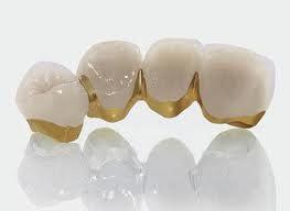 Ưu và nhược điểm của các loại răng sứ