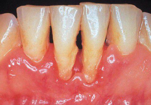 Tác dụng của cạo vôi răng với sức khỏe răng miệng