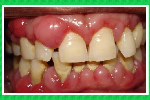 Viêm quanh răng là bệnh gì?-1