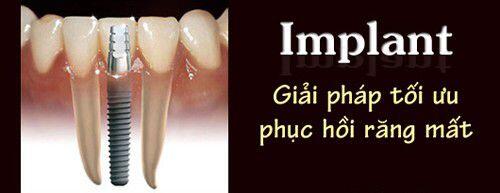 Yếu tố quyết định đến sự thành công của trồng răng Implant