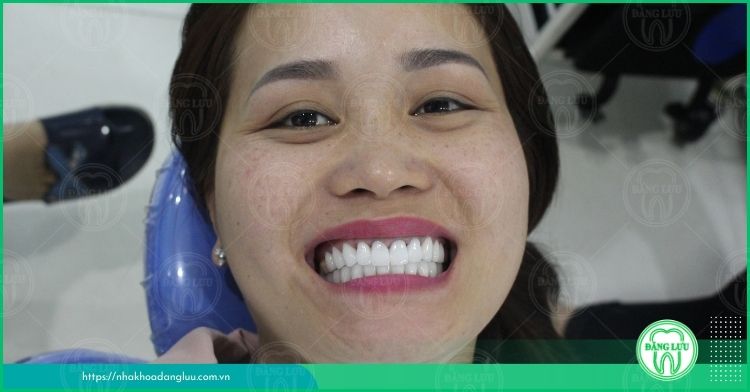 Bọc răng sứ thẩm mỹ khôi phục hàm răng đều đẹp
