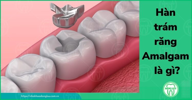 trám răng Amalgam là gì