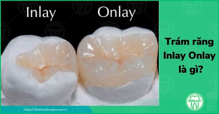 Trám răng Inlay Onlay là gì?-1