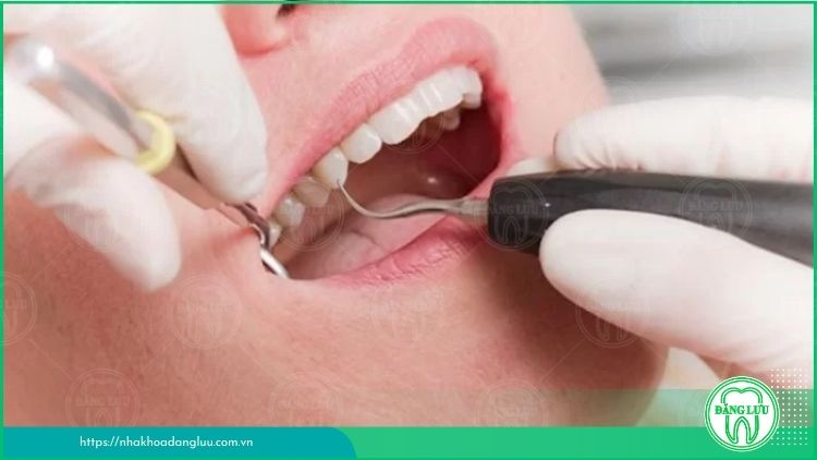 Các phương pháp cạo vôi răng được ứng dụng hiện nay