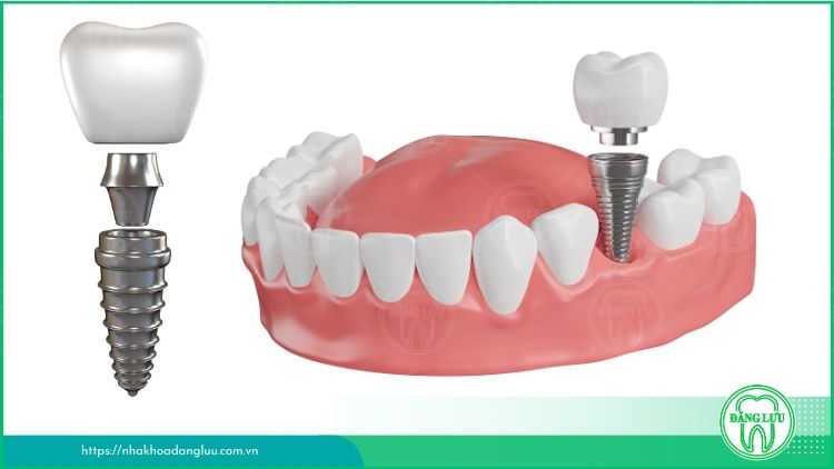 Cấu trúc răng Implant