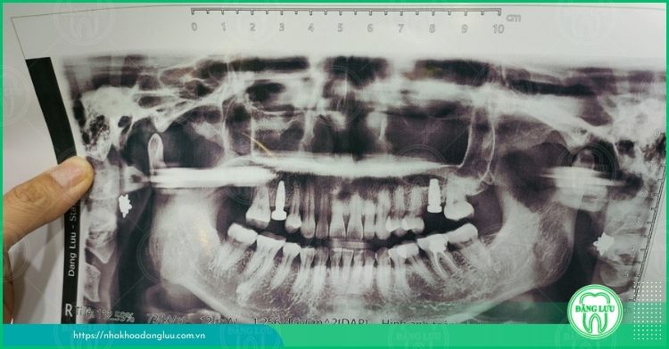 chụp x-quang răng hàm