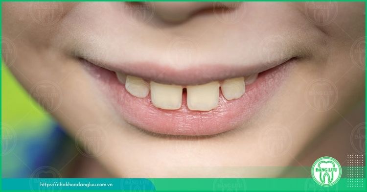 Những đặc điểm của răng hô hàm trên