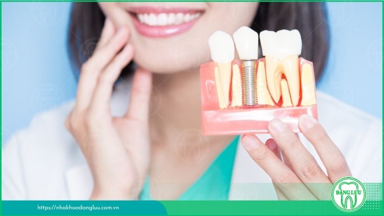 Những lưu ý khi chọn răng Implant phù hợp