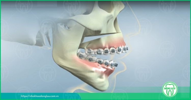 phẫu thuật kết hợp với niềng răng hô
