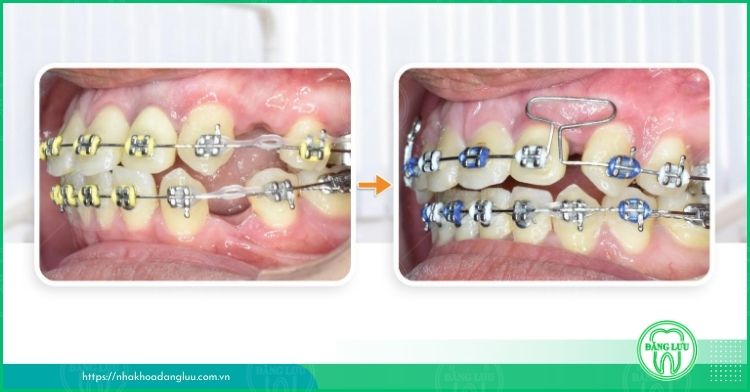 Loop đóng khoảng răng cửa là gì? Giai đoạn này mất bao lâu?