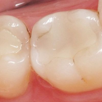 trám răng composite có bền không