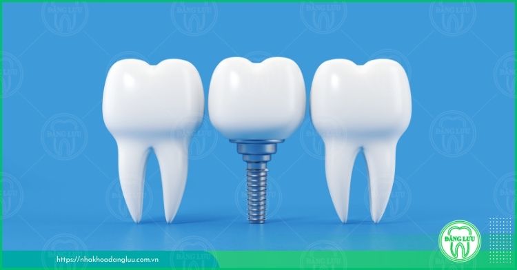 Trồng răng implant ở đâu tốt an toàn