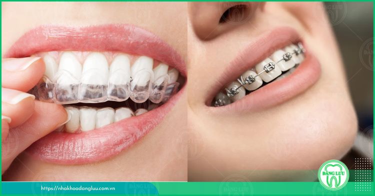 phương pháp niềng răng hiệu quả và an toàn