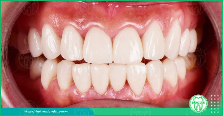 tìm hiểu độ bền của răng sứ thẩm mỹ