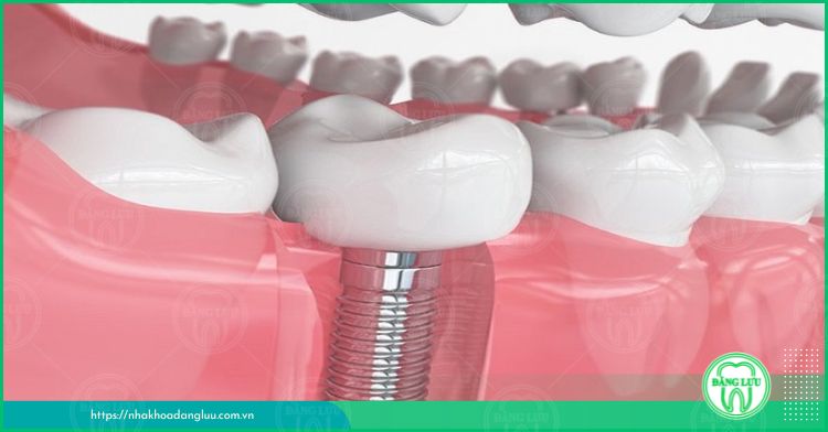 trồng răng hàm số 7 bằng phương pháp implant