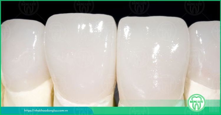 Bảo vệ răng sứ Cercon trắng đẹp