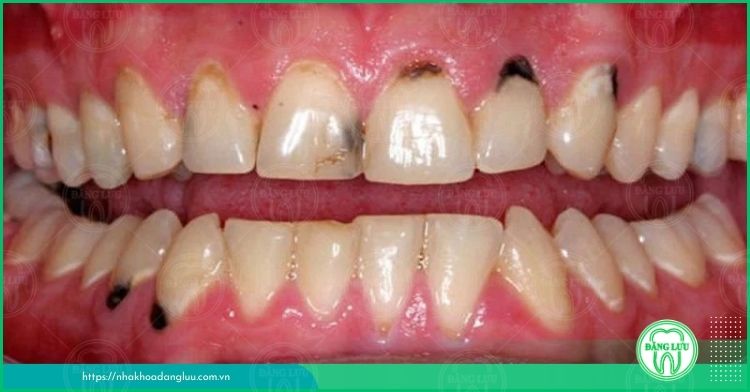 cao răng xuất hiện trên răng
