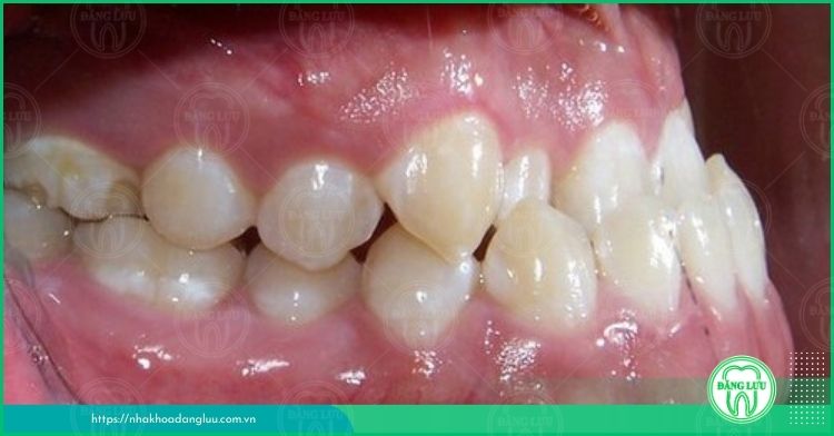 hàm răng móm cần khắc phục