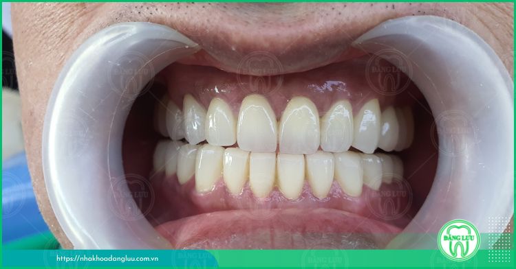 quy trình thực hiện bọc răng sứ nguyên hàm