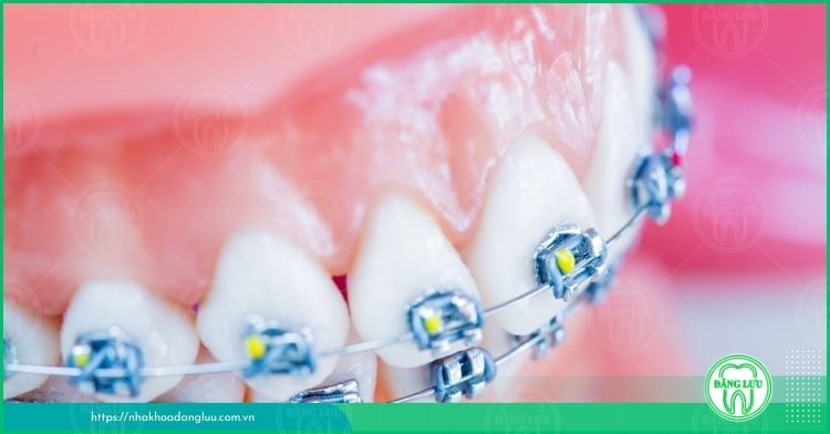 tổng quan về phương pháp niềng răng