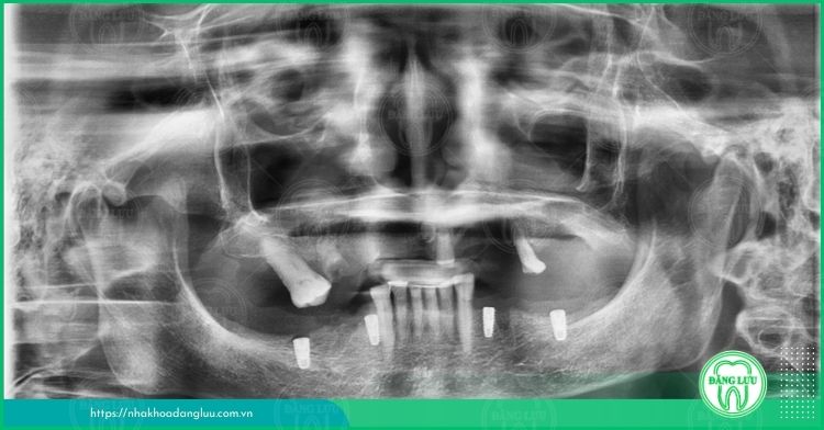 trồng răng cố định với implant