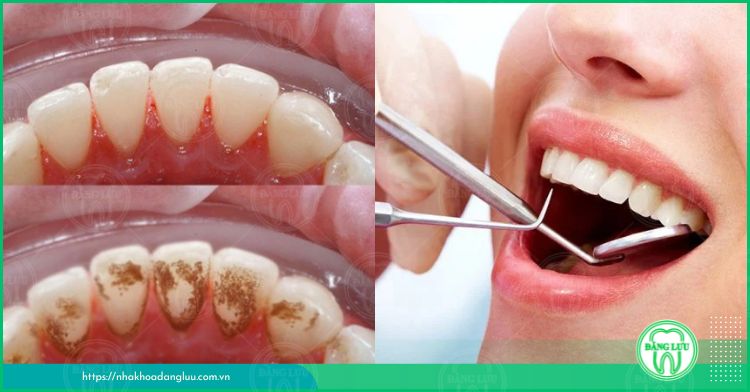 xử lý cao răng an toàn tại nha khoa