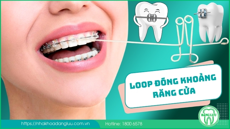 Loop đóng khoảng răng cửa là gì? Giai đoạn này mất bao lâu?