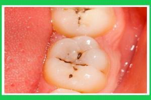 Lỗ sâu răng phát triển như thế nào?-1
