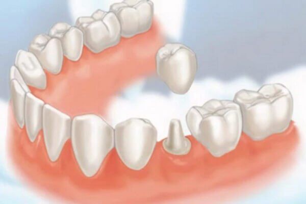 Các phương pháp bọc răng sứ hiện nay-1