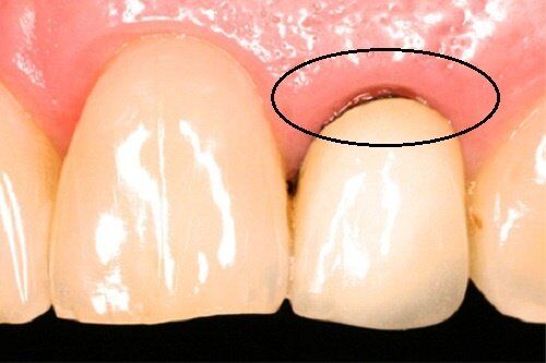 Bọc răng sứ Cercon có hại không?