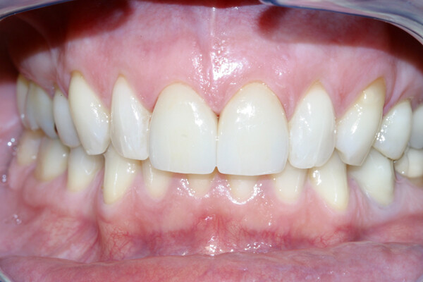 Bọc răng sứ có cần thiết phải lấy tủy răng?