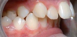 Bọc răng sứ cho răng hô 1