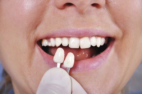 Bọc răng sứ Veneer có hại không?