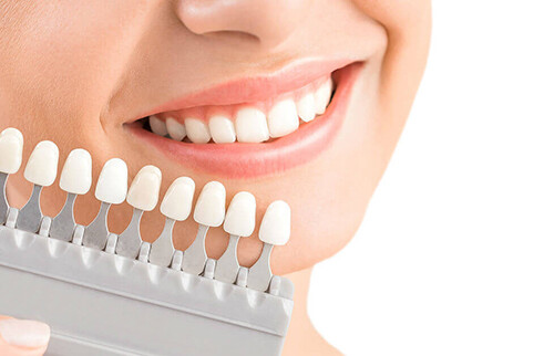 Quy trình bọc răng sứ Veneer tiêu chuẩn Nha khoa
