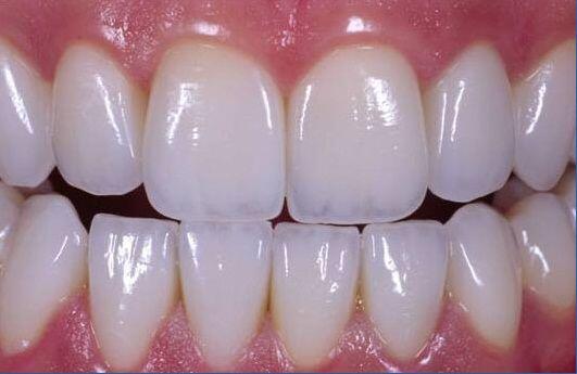 Những thắc mắc liên quan đến việc bọc răng sứ